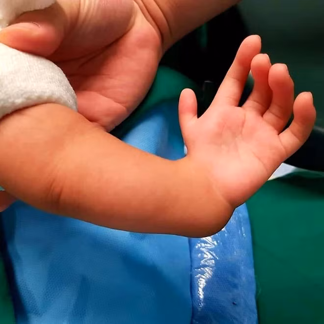 Tay bé bị tật