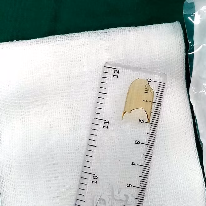 Mảnh thuỷ tinh được bác sĩ lấy ra từ họng bé gái