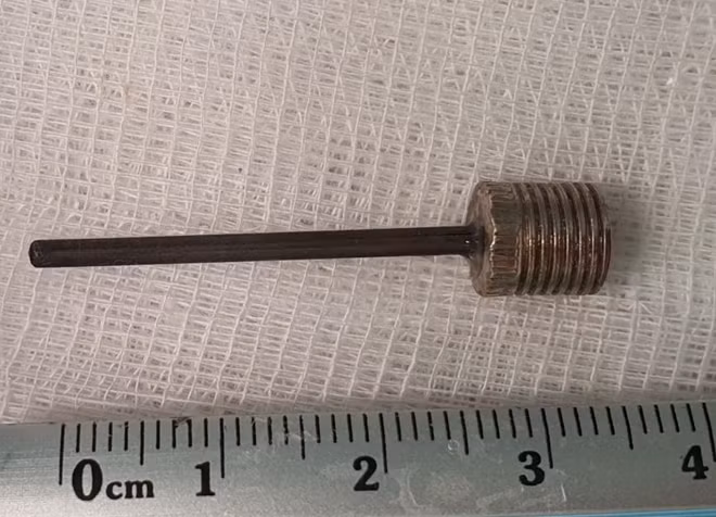 Van thổi bóng khá dài được BS lấy ra từ bé trai 12 tuổi