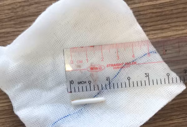 Dị vật được gắp ra là một thanh nhựa trắng, mảnh, dài khoảng 2cm