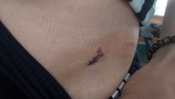 Vết thương trên đầu rách, khâu 5 mũi và vết thương mũi bên hông trái cũng bị khâu 2 mũi.