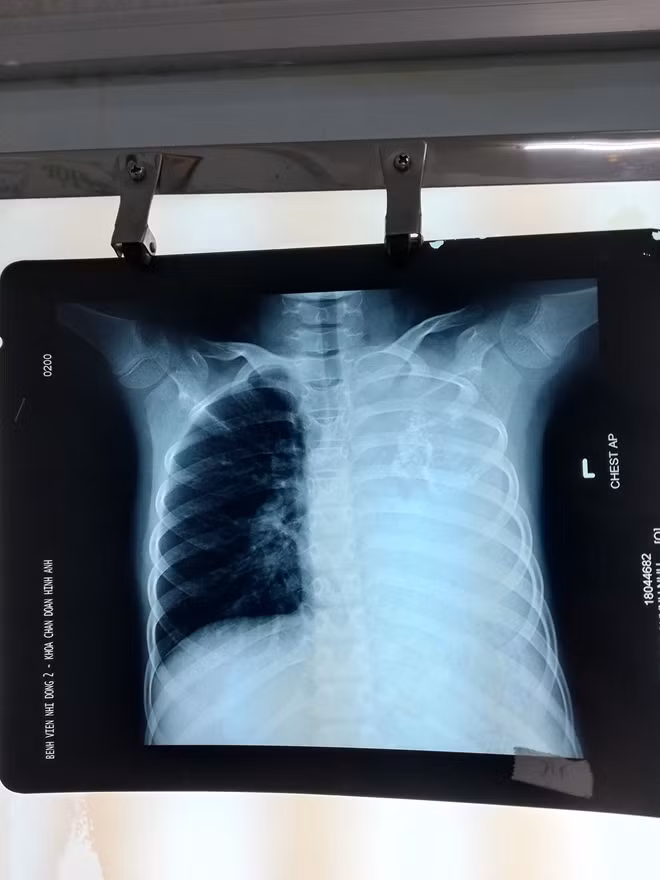 Hình ảnh khối u choán hết phần phổi bên trái qua chụp X-Quang.