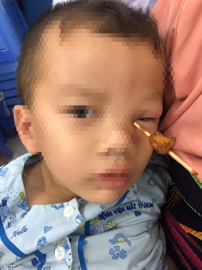 Bé trai khi mới nhập viện trong tình trạng que xiên thịt trúng hốc mắt trái