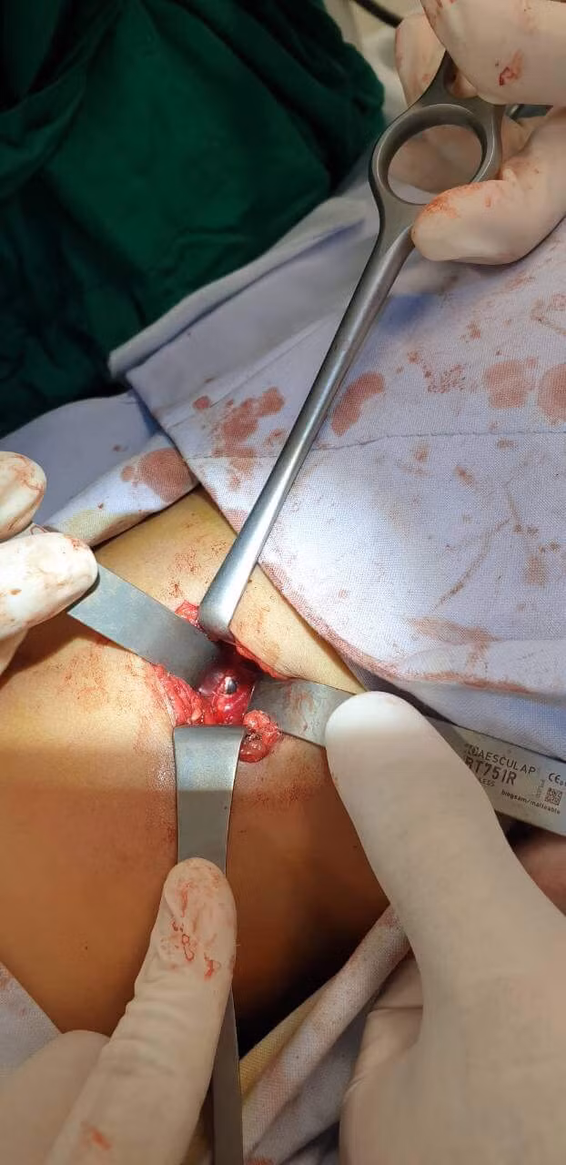 Viên đạn bi đã được lấy ra ngoài thành công. Viên đạn bi đã được lấy ra ngoài thành công.