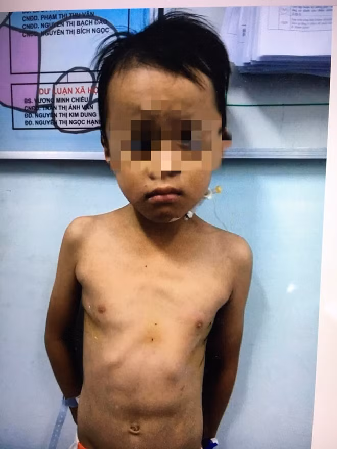 Bé trai đã hồi phục sức khoẻ nhanh chóng, vết mổ nội soi rất nhỏ trên cơ thể.