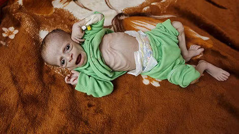 Một đứa trẻ Yemen suy dinh dưỡng trầm trọng.