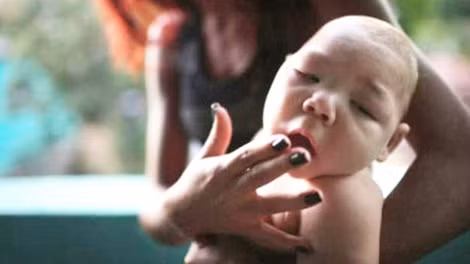 Bệnh teo não ở trẻ sơ sinh do mẹ nhiễm virus zika.