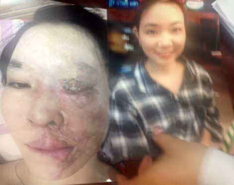 Gương mặt của bị hại Hương trước và sau khi bị tạt axit. Gương mặt của bị hại Hương trước và sau khi bị tạt axit.