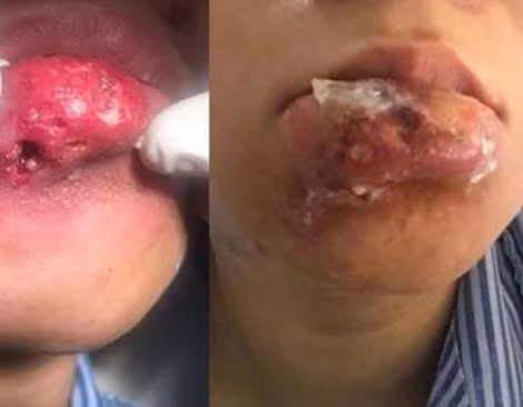 Môi bệnh nhân bị hoại tử sau tiêm Filler. Môi bệnh nhân bị hoại tử sau tiêm Filler.