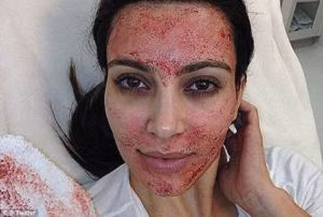Năm 2015, người mẫu Kim Kardashian sử dụng máu từ cánh tay để trẻ hóa làn da mặt.