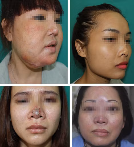 Một số tai biến sau phẫu thuật thẩm mỹ nâng ngực, làm mũi, mí, bơm căng da mặt v.v… Một số tai biến sau phẫu thuật thẩm mỹ nâng ngực, làm mũi, mí, bơm căng da mặt v.v…