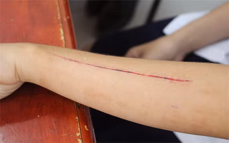 Vết thương trên tay em X.Q. do cứa tay vào thanh sắt cầu thang ở trường.