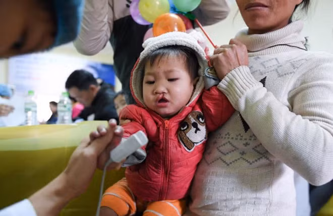 Cũng giống anh A Chứ, chị Lường Thị Hà (xã Nặng Mười, huyện Văn Chấn, Yên Bái) một mình đưa con trai Bàn Tiến Đạt (23 tháng tuổi) xuống Hà Nội thăm khám. Chị cho biết lúc mang bầu có đi khám nhưng không phát hiện dị tật, đến lúc sinh con ra mới biết bé bị hở hàm ếch. “Buồn lắm vì đứa đầu lành lặn, đứa hai lại như vậy nên tôi rất mặc cảm”. Cũng giống anh A Chứ, chị Lường Thị Hà (xã Nặng Mười, huyện Văn Chấn, Yên Bái) một mình đưa con trai Bàn Tiến Đạt (23 tháng tuổi) xuống Hà Nội thăm khám. Chị cho biết lúc mang bầu có đi khám nhưng không phát hiện dị tật, đến lúc sinh con ra mới biết bé bị hở hàm ếch. “Buồn lắm vì đứa đầu lành lặn, đứa hai lại như vậy nên tôi rất mặc cảm”.