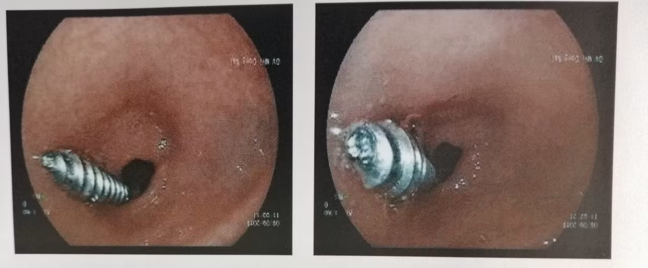 Phẫu thuật nội soi, lấy ốc vít từ da dày bé trai 18 tháng tuổi