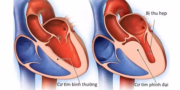 Viêm cơ tim nặng có thể gây đột tử