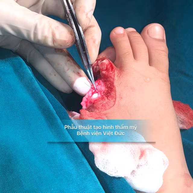 Hai ngón chân của bé bị đứt