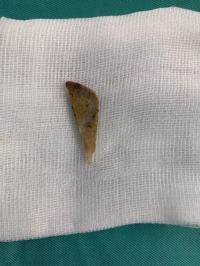 Mảnh xương có kích thước 5cm, chiều rộng 1cm lấy ra từ ruột non bệnh nhân