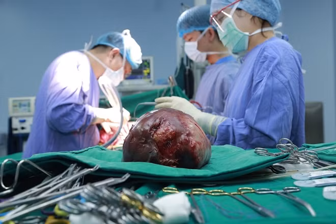 Khối u gan khổng lồ được lấy ra