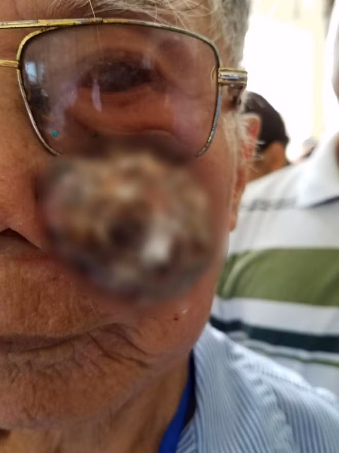 Cụ ông mang khối u má trái "khủng" suốt 3 năm