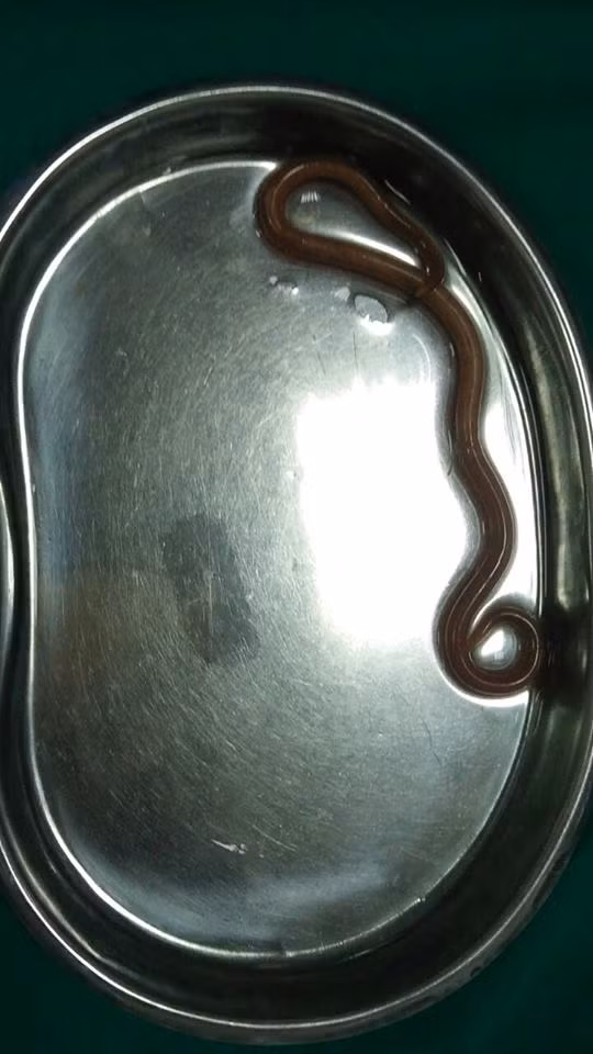 Giun đũa được gắp ra khỏi dạ dày bệnh nhân