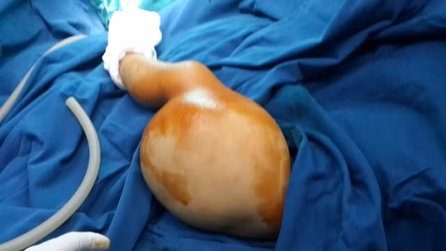 Khối u bạch huyết khổng lồ của bé trai đã được cắt bỏ