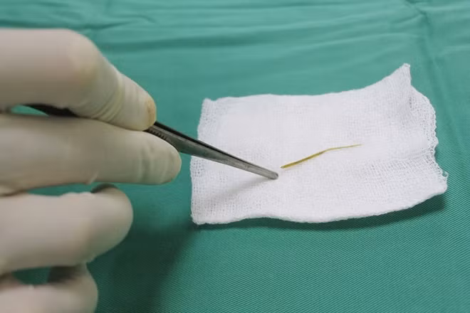 Mảnh xương cá được lấy ra