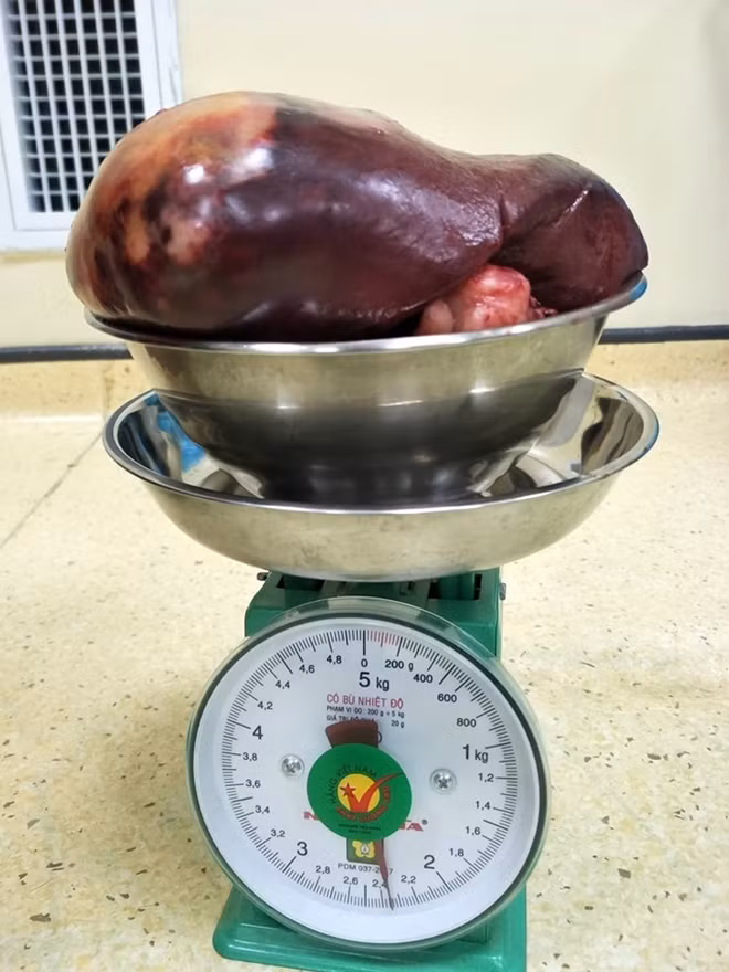 Khối u lách nặng 2,3kg được lấy ra khỏi người bệnh nhân 24 tuổi