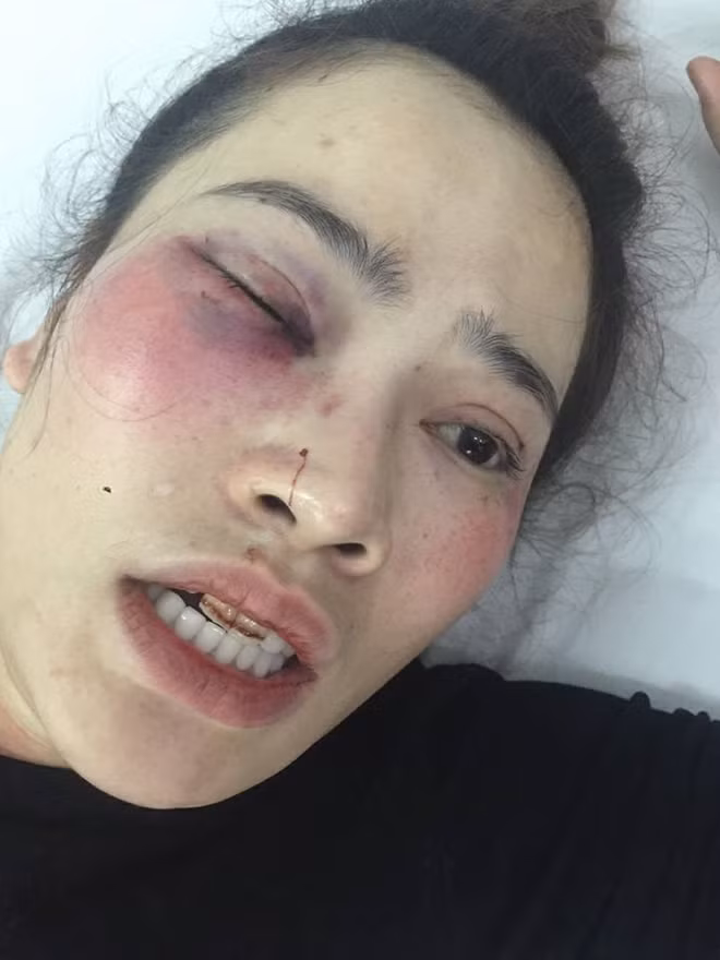Chị Như bị nhiều thương tích vùng mặt sau khi bị hành hung