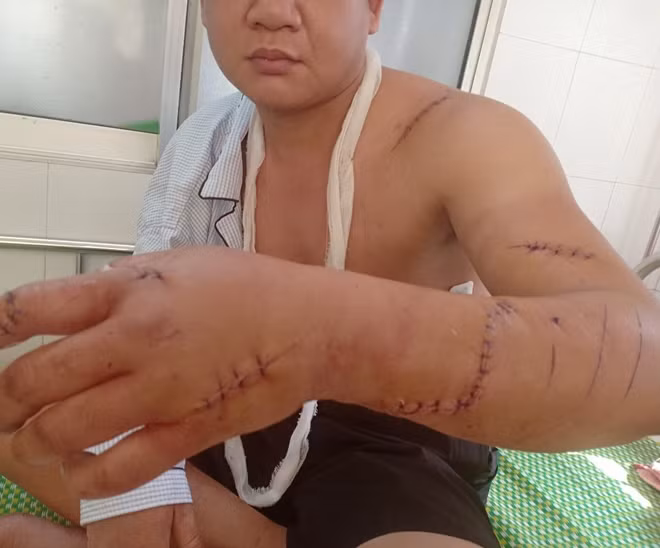 Nhiều vết thương trên người anh Đăng do bị chém bằng dao chặt dừa.