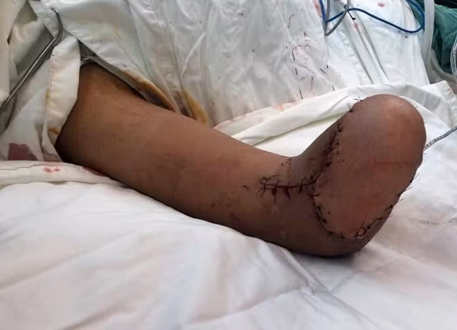 Sau nhiều ca phẫu thuật liên tiếp, cánh tay phải bệnh nhân H. được các bác sĩ tạo vùng da che phủ khuyết hỗng để sau này làm chi tay giả.