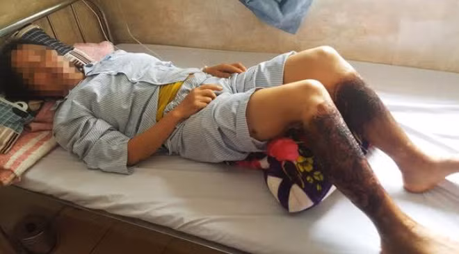 Bà L. bị bỏng 2 chân điều trị tại bệnh viện.