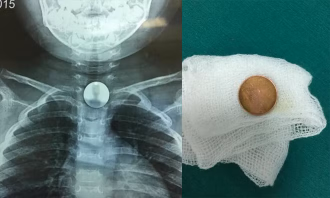 Kết quả chụp phim cho thấy đồng xu mắc trong cổ họng cháu bé và đồng xu đã được lấy ra.