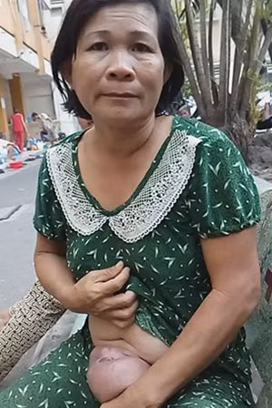 Bệnh nhân Nguyễn Thị Nhành với khối u tai quái.