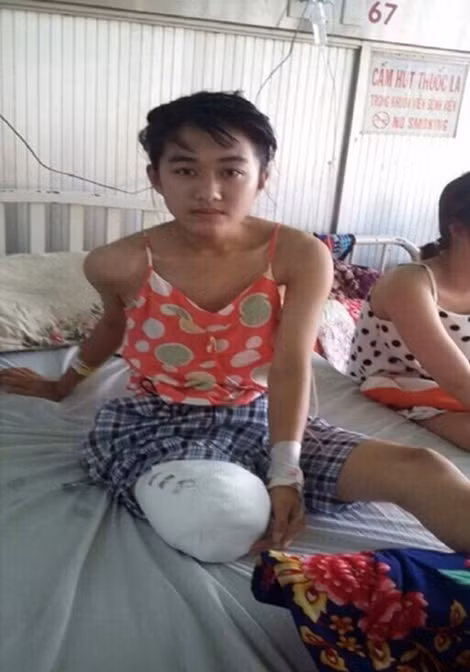 Em Vi bị cưa cụt một chân đang được điều trị tại Bệnh viện Chợ Rẫy. Ảnh do gia đình cung cấp.