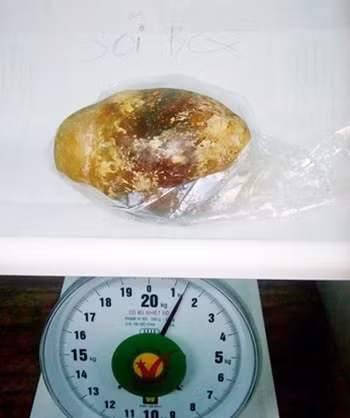 Viên sỏi bàng quang nặng... 1,5kg.