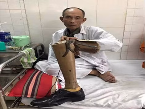 Thương binh hạng 2/4 Hoàng Tiến Vin đang điều trị tại bệnh viện.