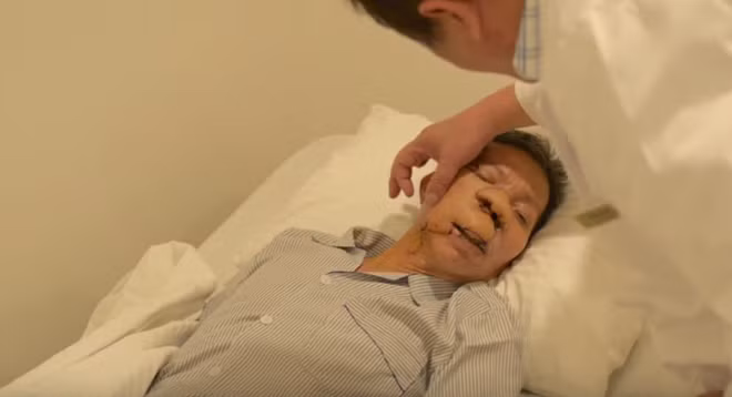 5 ngày sau mổ, ông Sứ đã hồi phục sức khỏe, khối u được loại bỏ, phần tạo hình tiến triển tốt