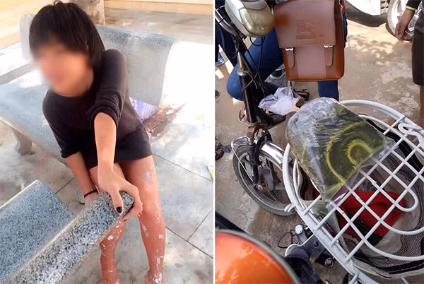 Nữ sinh cấp 2 bị bỏng ở chân cùng túi xăng.