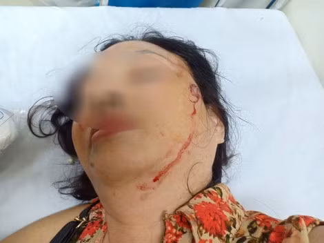 Những vết thương của bà Ngân sau khi xô xát.