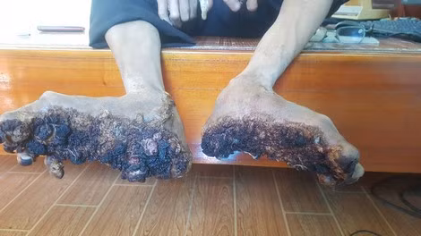 Đôi bàn tay, bàn chân như dễ cây xù xì khiến anh Sơn không thể đi lại được. Đôi bàn tay, bàn chân như dễ cây xù xì khiến anh Sơn không thể đi lại được.
