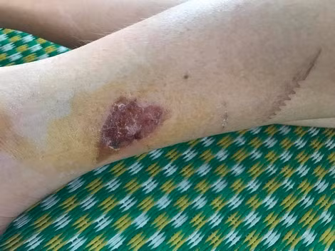 Vết thương của Duy vẫn chưa liền sẹo.