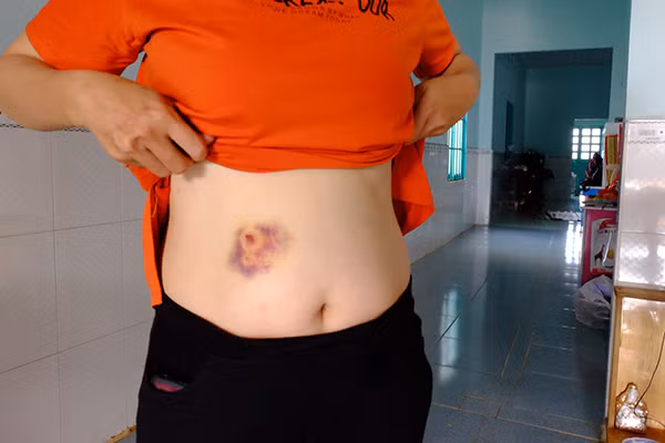 Vết bầm tím do bị mẹ con bà Tuyết đánh đập ở vùng bụng chị Nguyễn Thị Thúy Hằng đang mang thai 5 tháng