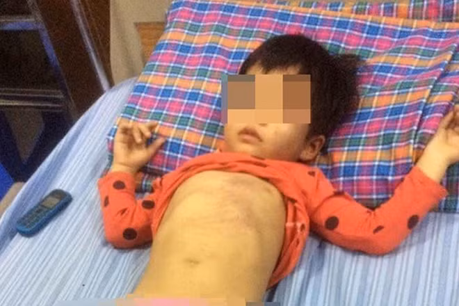 Cháu Lê Thùy D với thương tích trên người nghi bị cô giáo đánh