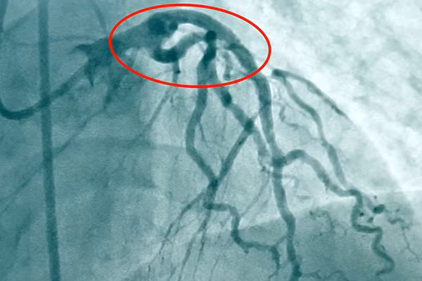 Mạch máu bệnh nhân hoạt động bình thường trở lại sau khi được đặt stent thành công.