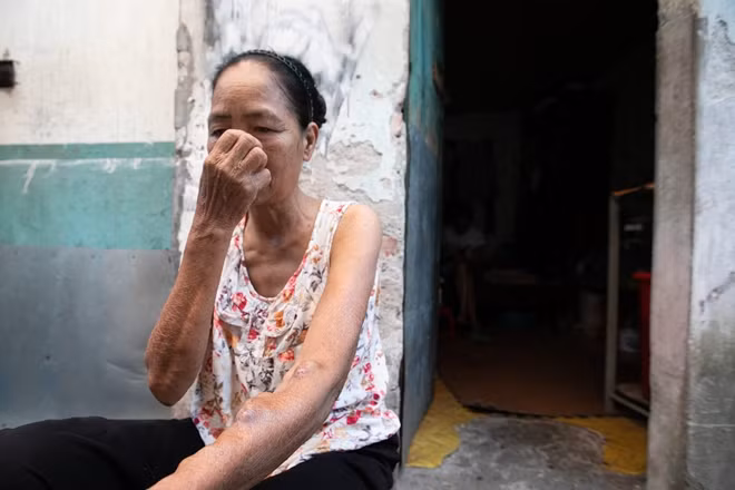 "Người chạy thận tay phải u lên thế này mới tốt, chứ cứ phẳng lỳ là nguy hiểm lắm".