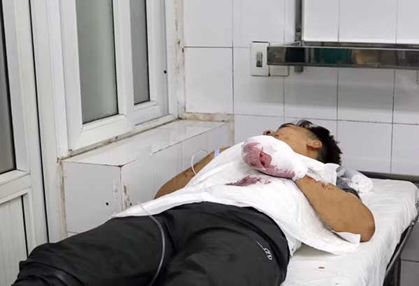 Một bệnh nhân bị thương ở tay do pháo nổ. Một bệnh nhân bị thương ở tay do pháo nổ.