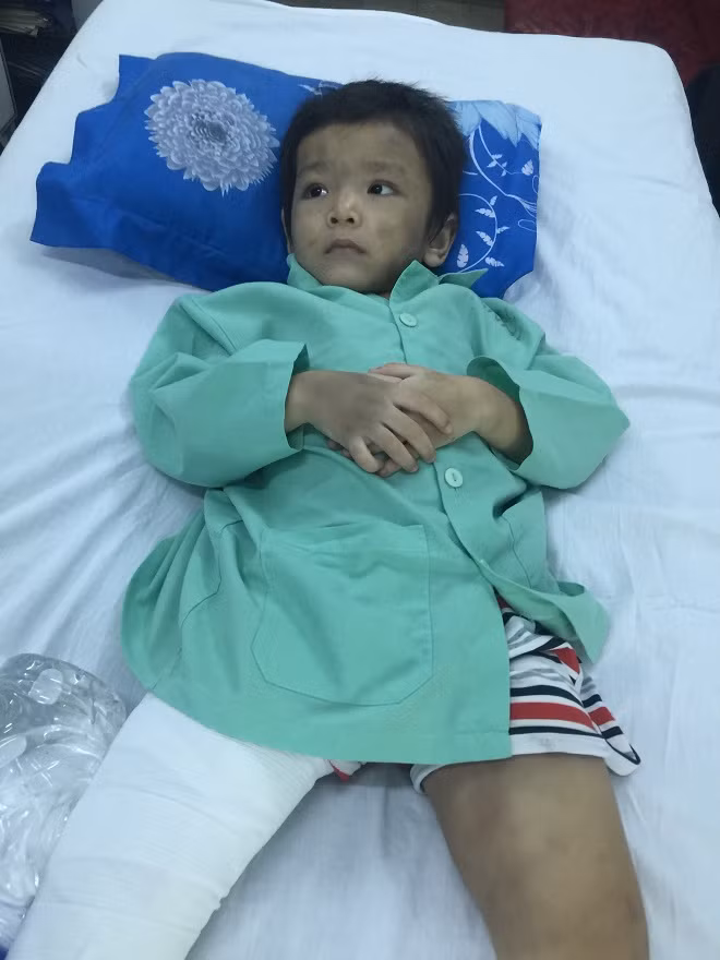 Bé Th. đang được theo dõi điều trị tại khoa Chỉnh hình Nhi, BV Chấn thương Chỉnh hình TP Hồ Chí Minh.