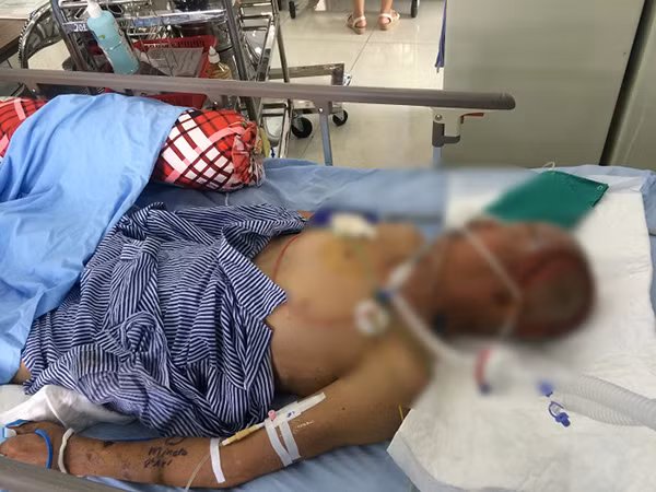 Ông Hiền bị chó dữ tấn công đã tử vong sau gần 2 tháng nằm bất tỉnh Ông Hiền bị chó dữ tấn công đã tử vong sau gần 2 tháng nằm bất tỉnh