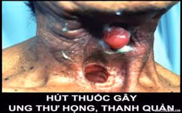 Hút thuốc gây ung thư vòm họng, thanh quản.