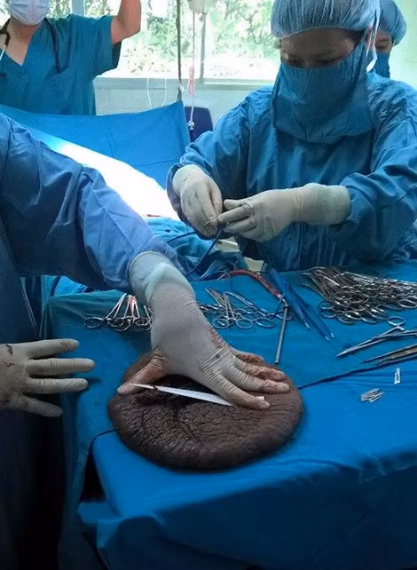 Khối bướu nặng 1,05kg đã được tách bỏ thành công.